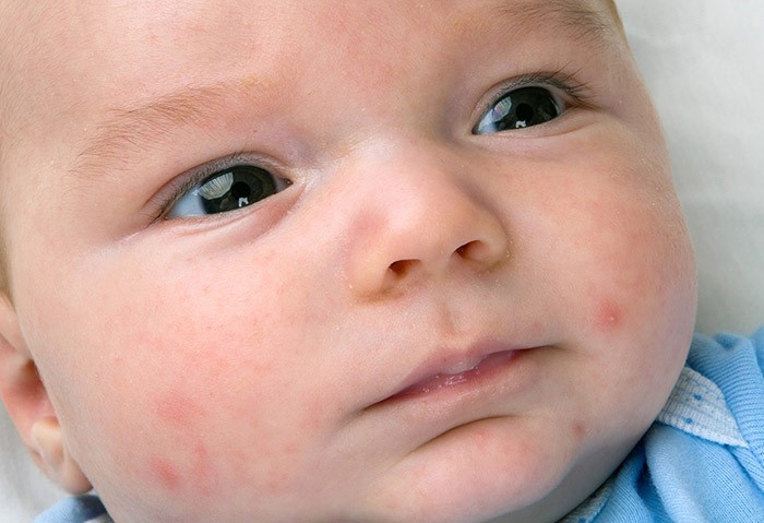 bebeklerde goz sulanmasi neden olur sebepleri ve tedavisi nedir anneveadayi com