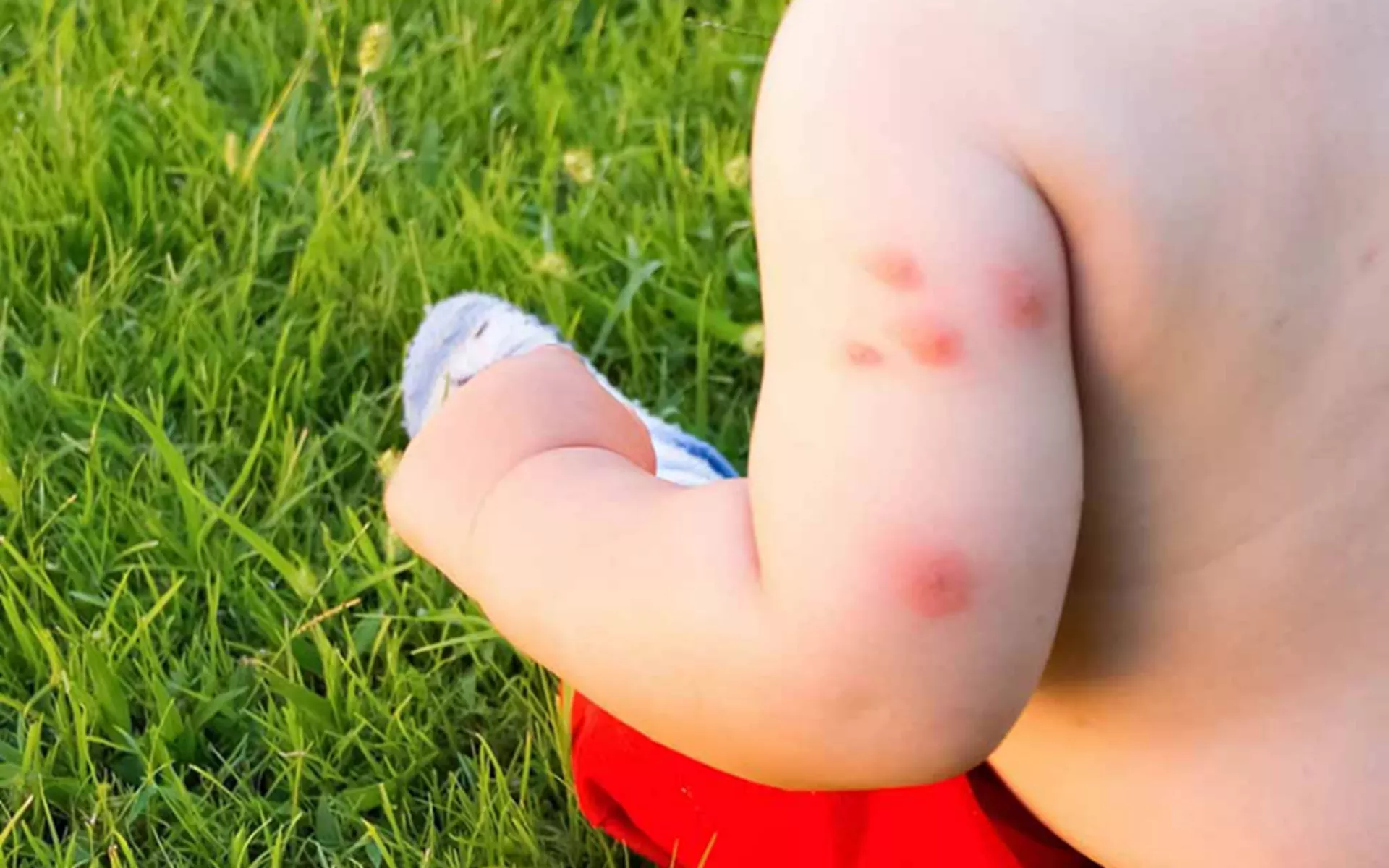 Bebeklerde Böcek Isırması Belirtileri Tanı ve Tedavi Yöntemleri Nelerdir?