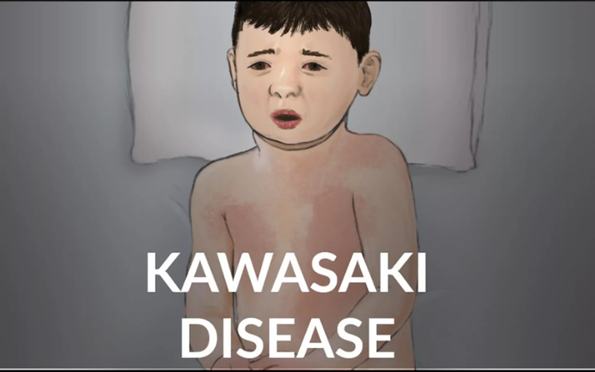 Kawasaki Hastalığı Sendromu Nedir? Belirti Tanı ve Tedavi Yöntemleri