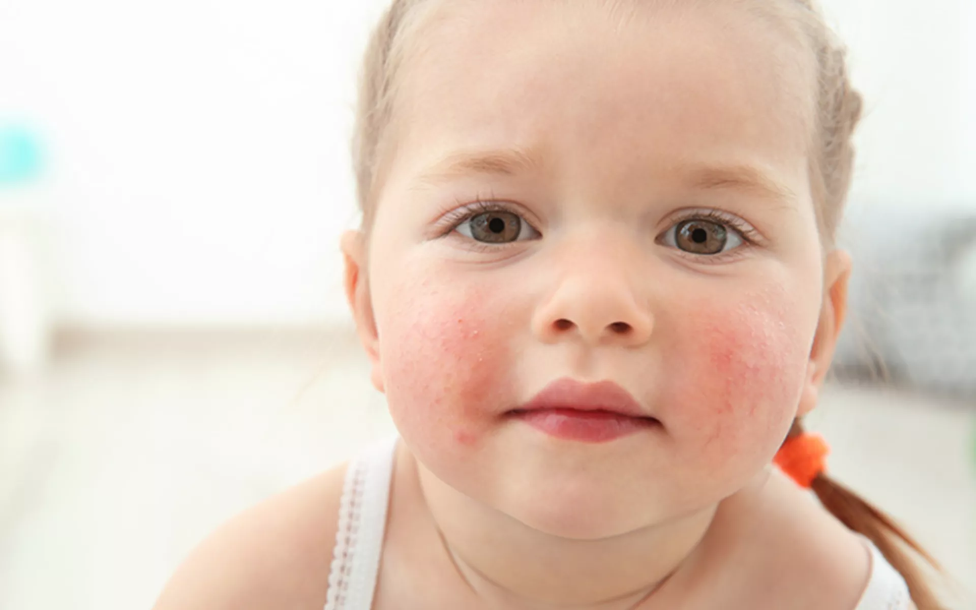 Çocuklarda Gıda Alerjisi Riskleri Nasıl Azaltılır? Önemli İpuçları