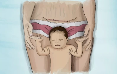 Sezeryan Doğum Türünü Önlemeye Yardımcı Olacak 10 İpucu