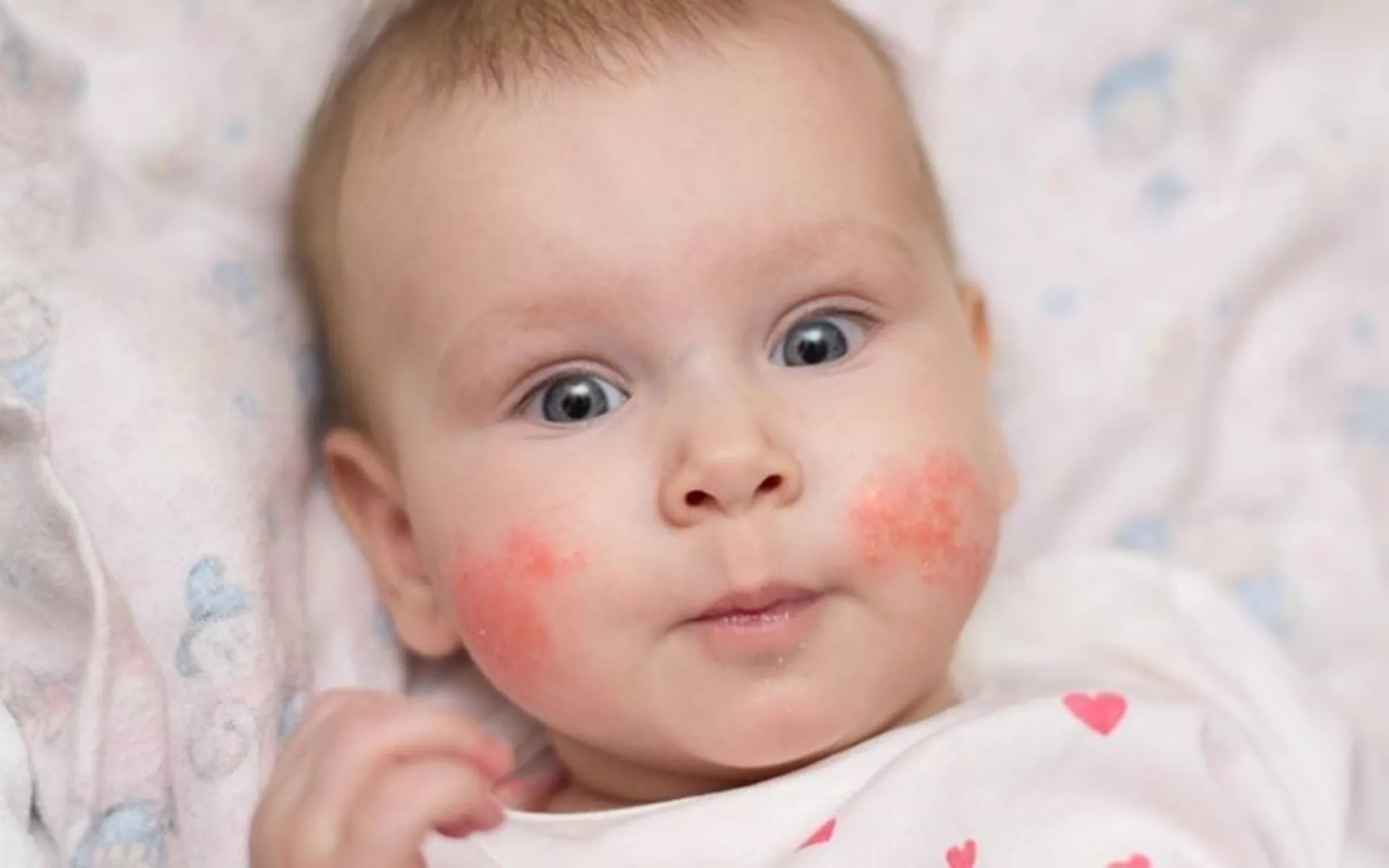 Bebeklerde Alerji Nedenleri Nelerdir? Hangi Alerjiler Tehlikelidir?