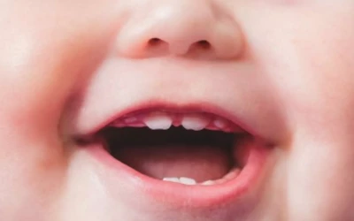 Bebeklerde Diş Lekeleri Neden Olur? Renklenme Nasıl Önlenir?
