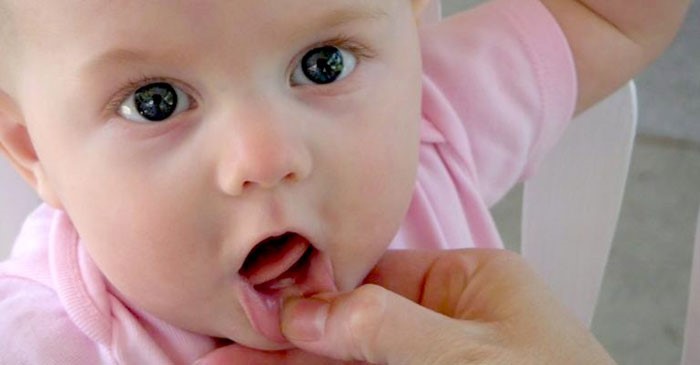  Bebeklerde Ağız Yaraları Neden Olur ve Nasıl Geçer?