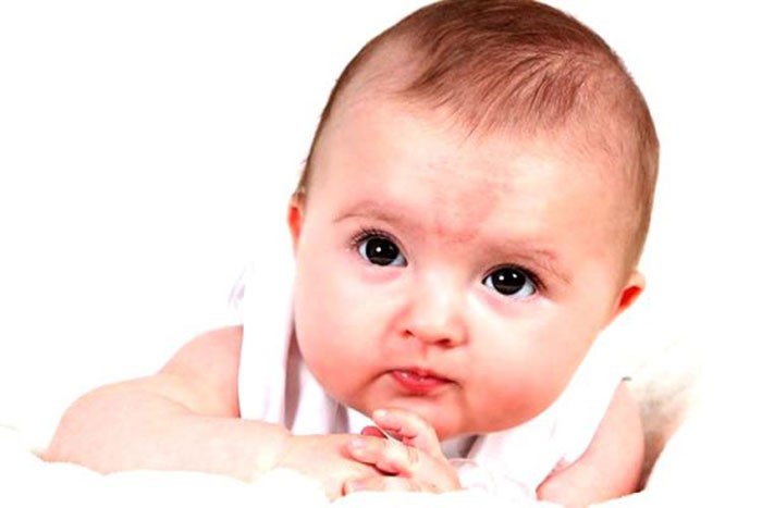 Bebeklerde Doğum Lekesi ve Tedavisi