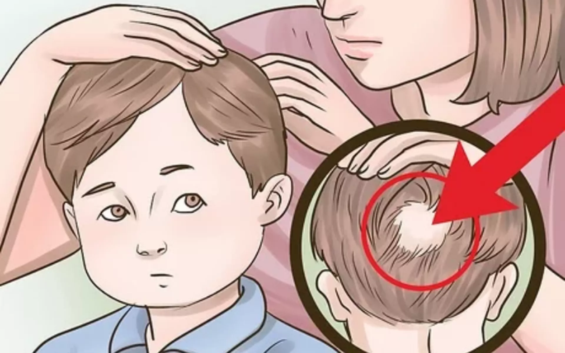 Çocuklarda Saç Dökülmesi Neden Olur ve Nasıl Tedavi Edilir?